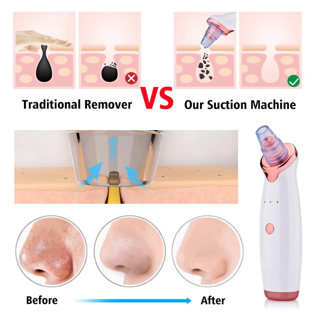 5 in 1 Blackhead remover | Rechargeable | Free Rs.500 Gift Card 🎁